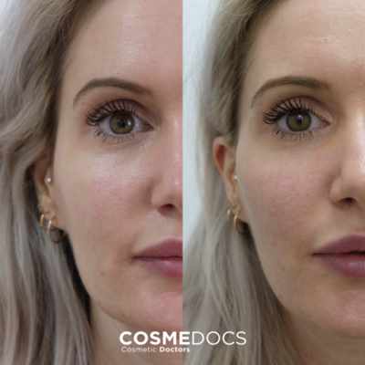 1ml cheek filler before and after London natural enhancement Cosmedocs