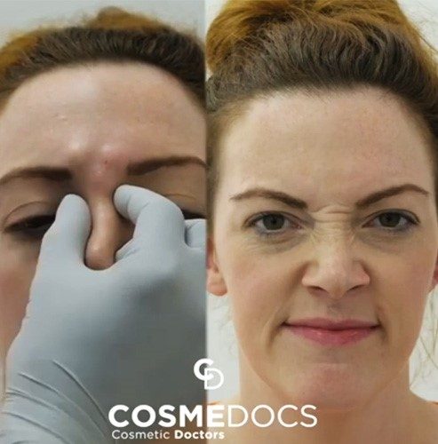 Bunny lines botox before and after treatment results showing reduced nose wrinkles and smoother nasal bridge at Cosmedocs London clinic