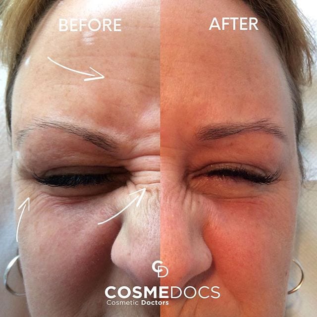 Combined forehead lines, crow's feet and bunny lines botox before after results demonstrating comprehensive upper face rejuvenation treatment