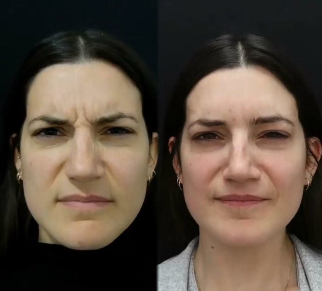 Nose wrinkles and bunny lines botox treatment before after comparison showing dramatic improvement in nasal wrinkles and smoother skin texture