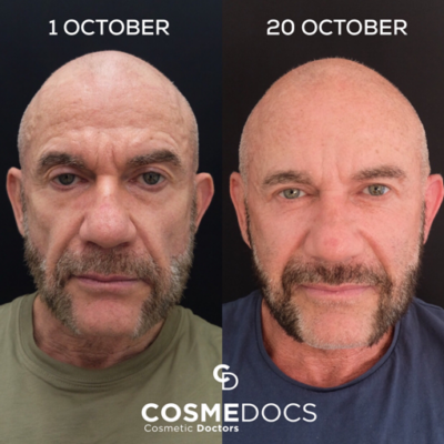 4ml male cheek filler before and after dramatic masculine transformation London