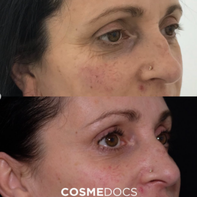 Crows feet botox before and after showing reduced eye wrinkles