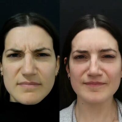 Before after crows feet botox treatment around eyes