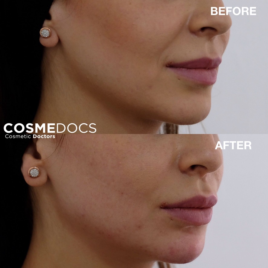 Mild lift and definition of the jawline with non-surgical treatment