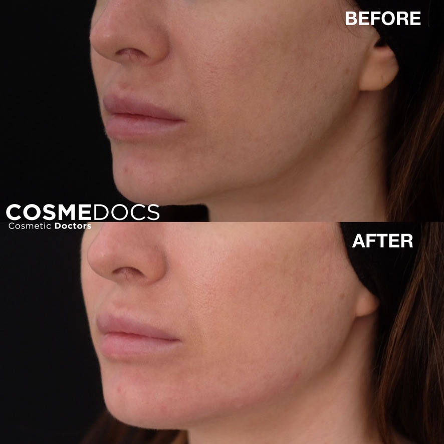 Loss of jaw angle leading to jowls, replaced and restored jawangle and jawline definition