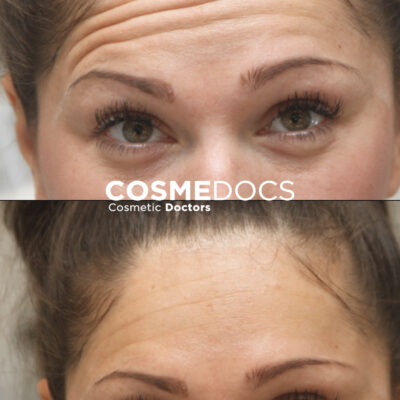 Combined effects of dermal fillers and Botox applied to forehead for facial rejuvenation