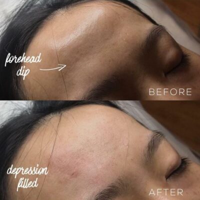 Before and after images showing the reduction of dips using forehead filler