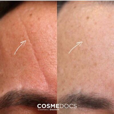 Forehead filler for sleep lines