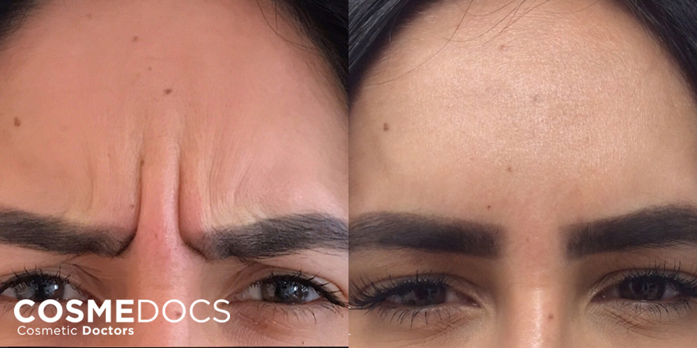 Frown lines smoothed by Botox, visible in before and after photos