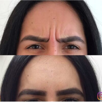 Harley Street Botox treatment results on frown lines