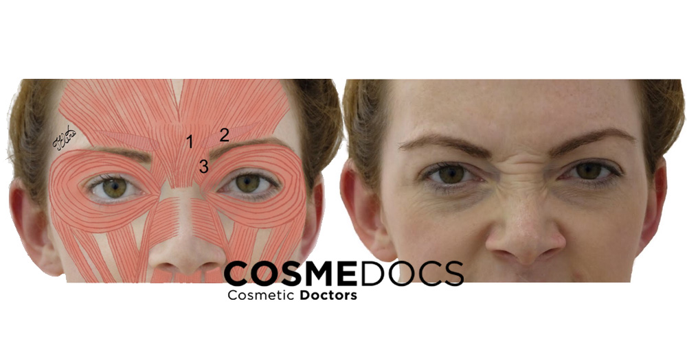 Botox 11 lines injection sites - glabellar lines treatment diagram