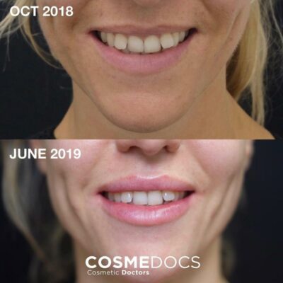 Gummy smile botox before and after - lip fillers with gummy smile improvement