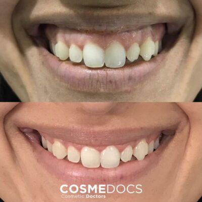 Gummy smile botox before and after treatment comparison