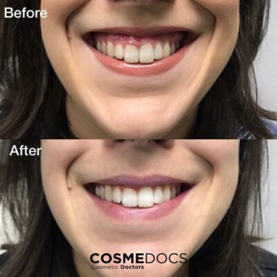 Gummy smile botox before after results