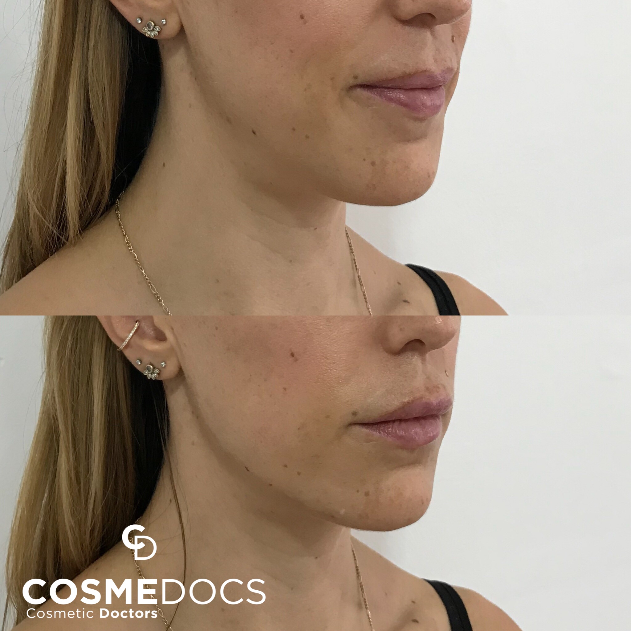 Jawline filler 1ml before after profile view Harley Street London Cosmedocs treatment results subtle enhancement