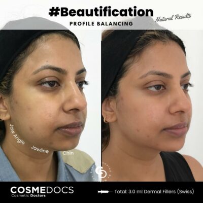 Comparison image of jawline and chin before and after filler treatments London Harley Street Cosmedocs