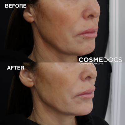 Jawline filler before and after London Harley Street jawline refinement with fillers