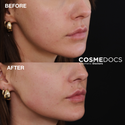 Before and after photos showcasing the enhancement of the lower facial profile with jawline and chin fillers London