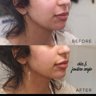 A dramatic before and after showcase of jawline and chin angle enhancement with fillers London Cosmedocs
