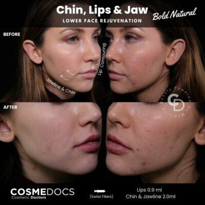 Lower face rejuvenation featuring chin, lips, and jawline fillers London Cosmedocs results