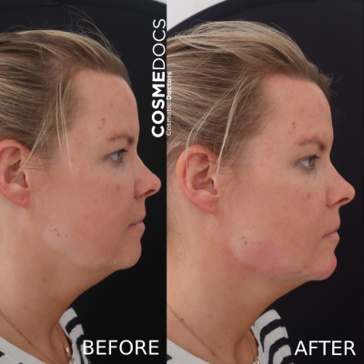 Jawline filler before and after London Harley Street jaw enhancement with fillers