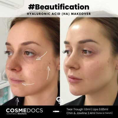 Before and after photo showcasing filler enhancements in the jawline, lips, chin and tear trough London