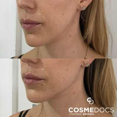 Jawline filler before and after 1ml jaw line filler per side London Harley Street