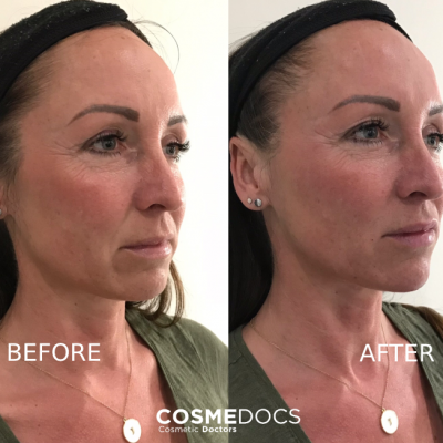 Jawline filler with chin enhancement before and after London Cosmedocs combined treatment