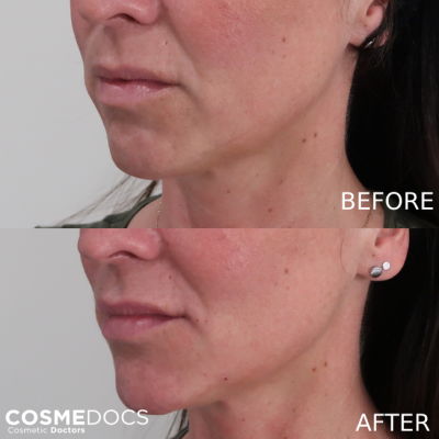 Jawline and chin fillers before and after transformation London Harley Street Cosmedocs