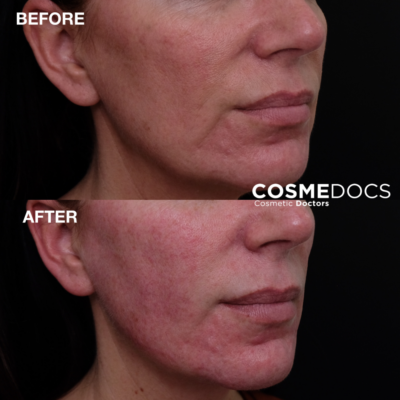 Before and after of jaw filler London jawline enhancement with fillers Cosmedocs