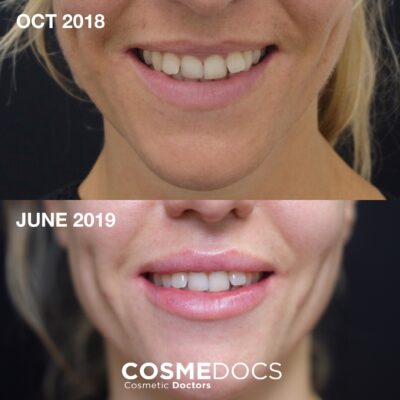 Lip flip botox before and after treatment