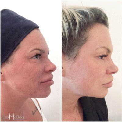 PDO thread lift before after natural facial rejuvenation