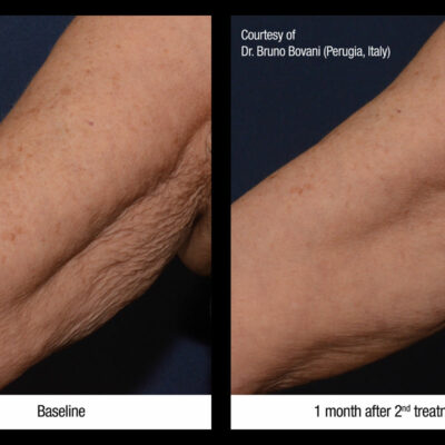 Profhilo arm treatment before and after skin thickness improvement