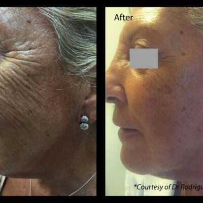 Profhilo cheek treatment before and after sun damaged skin improvement