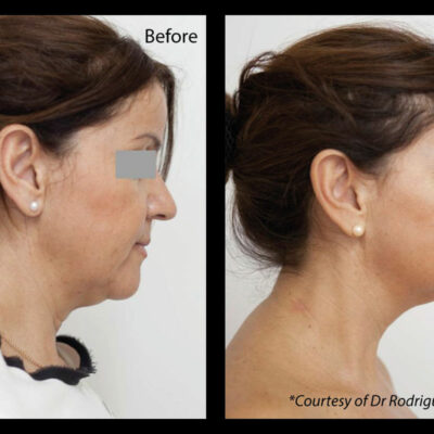 Profhilo face treatment before and after results London Harley Street Cosmedocs