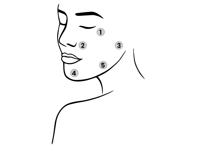 Profhilo injection points diagram showing BAP technique on face