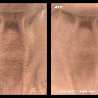 Profhilo neck treatment enhancing skin texture before and after