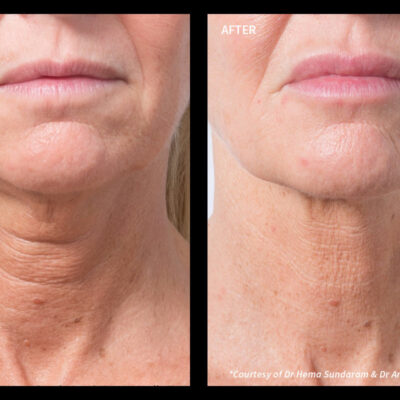 Profhilo neck treatment before and after transformation London