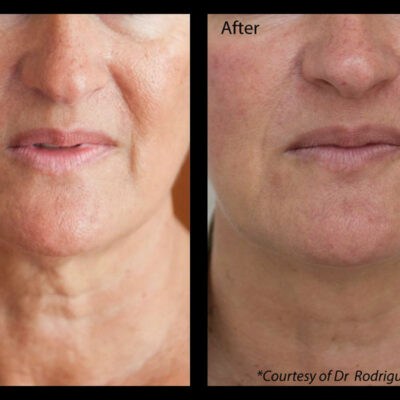 Profhilo neck and lower face treatment enhanced skin texture