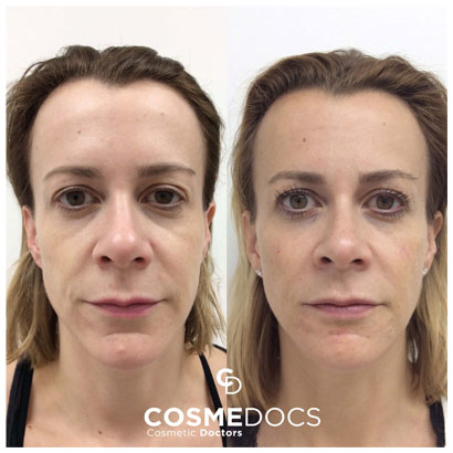 Smile line fillers under eyes and cheeks comprehensive treatment results