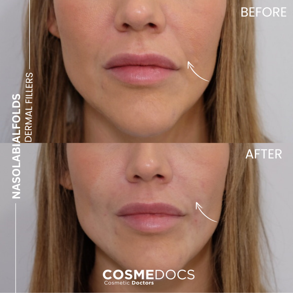 Nasolabial folds before and after dermal filler treatment case 1