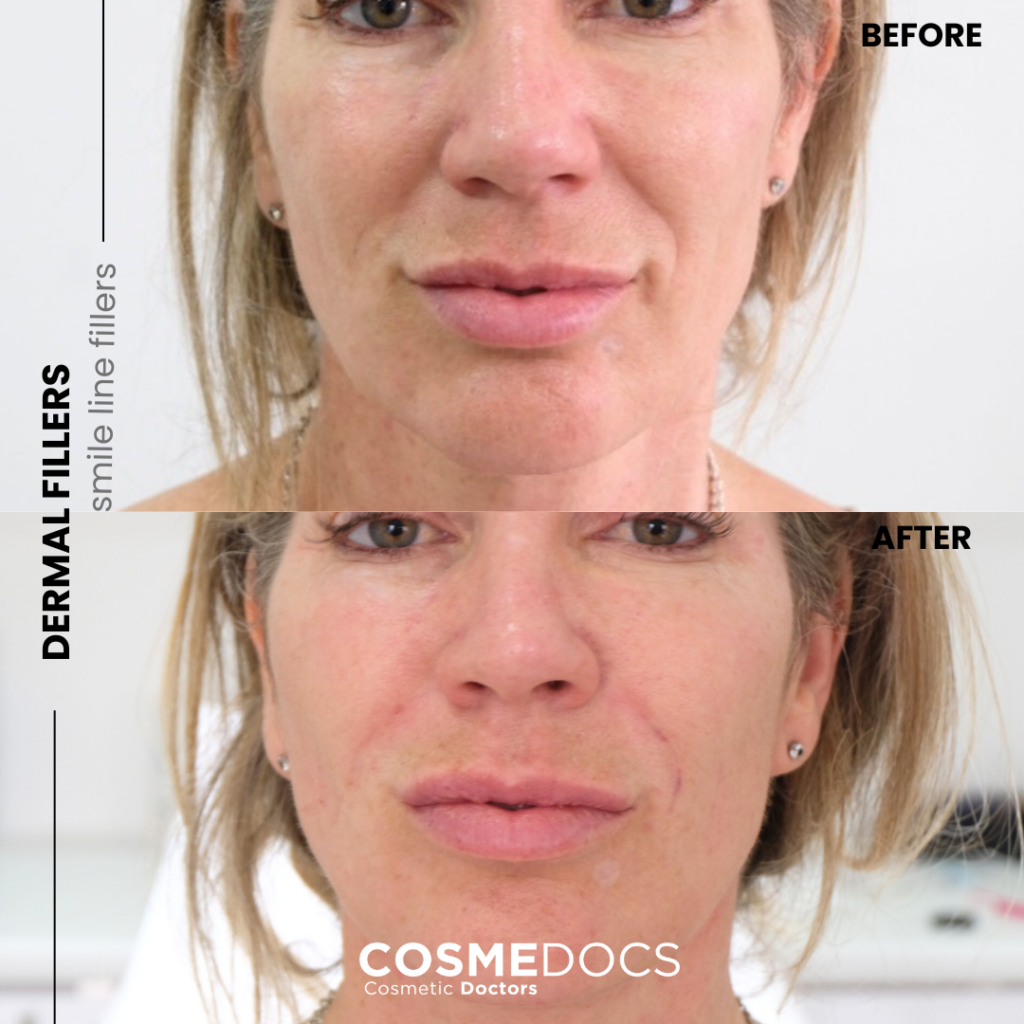 Nasolabial folds before and after dermal filler treatment case 2