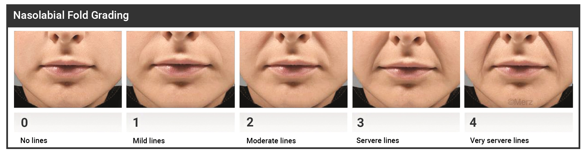 Nasolabial fold grading system from 0 to 4 showing severity levels