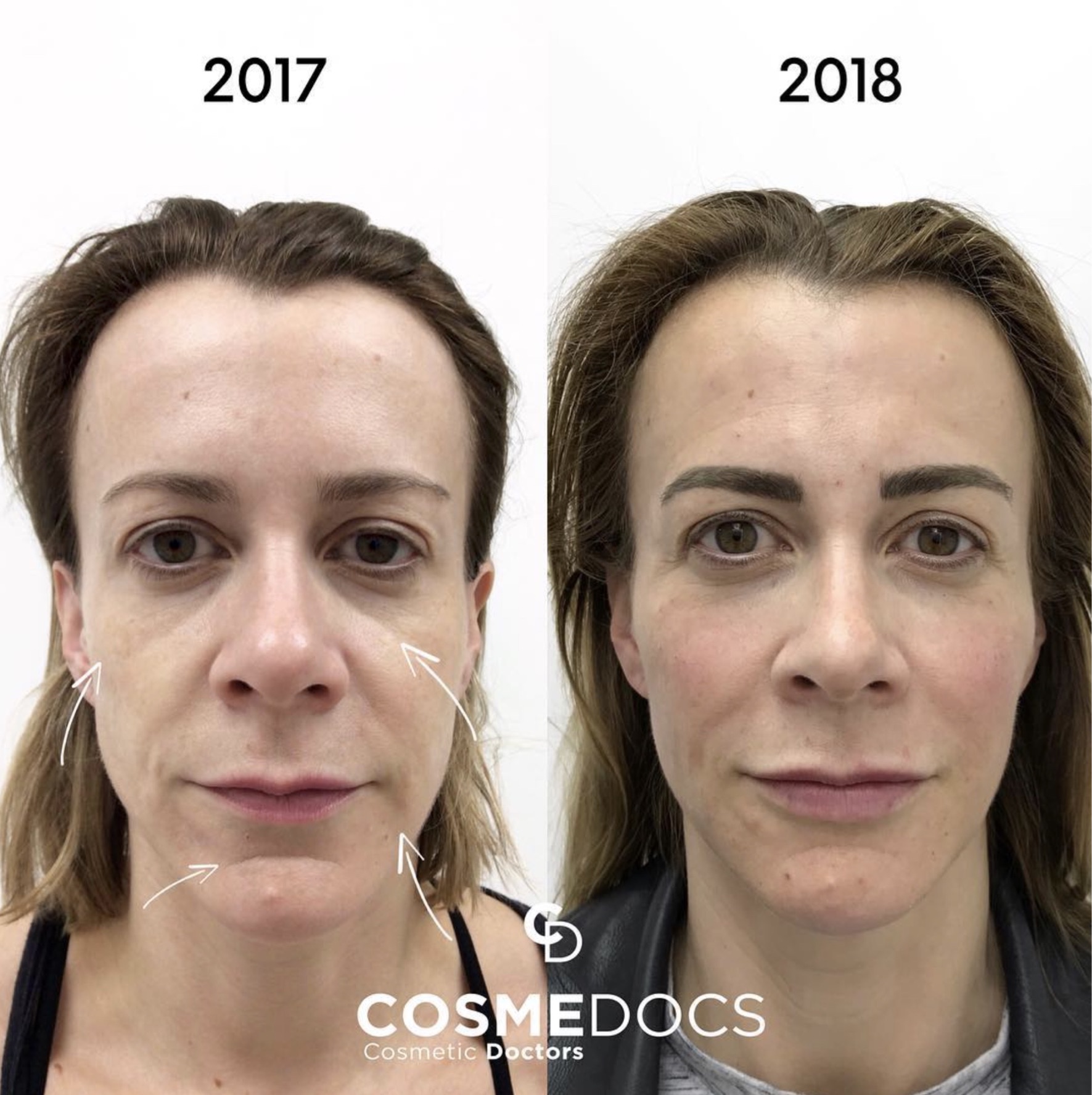 Before and after tear trough filler showing 2017 to 2018 transformation with reduced under-eye hollows