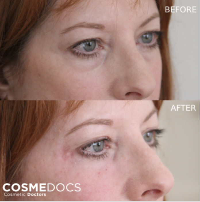 Before and after tear trough filler showing profile view of under-eye hollowing improvement