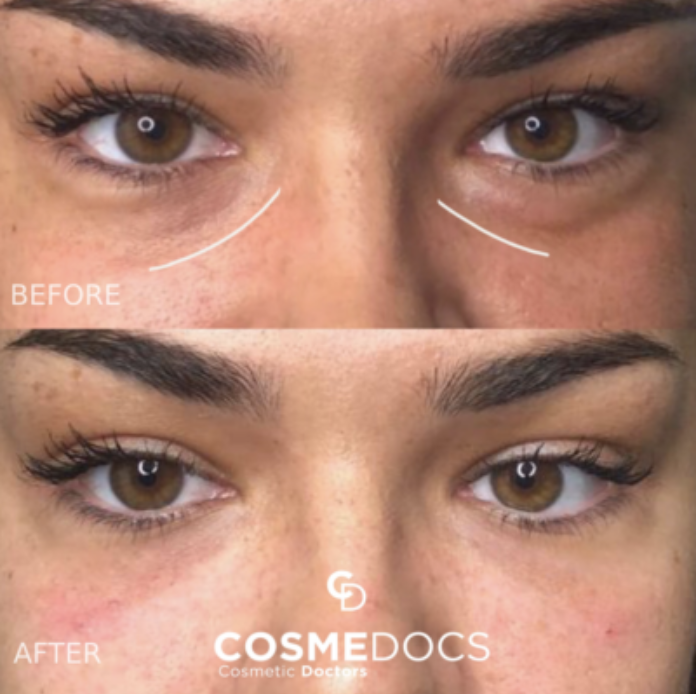 Before and after tear trough filler showing close-up under-eye smoothing and dark circle reduction