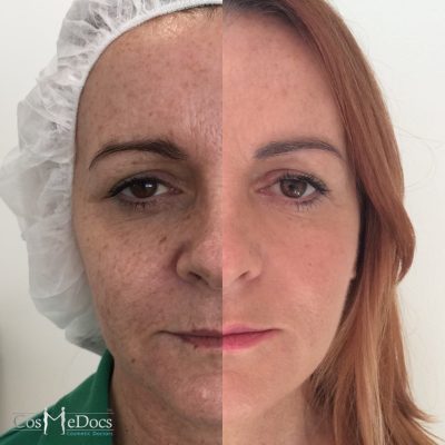 Thread face lift before and after image 2 weeks later - combination PDO thread lift