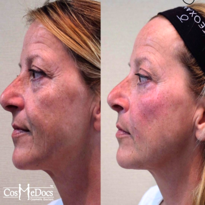 PDO thread lift before and after procedure final results