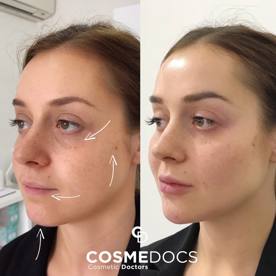 Before and after chin filler showing improved facial balance and lower face definition