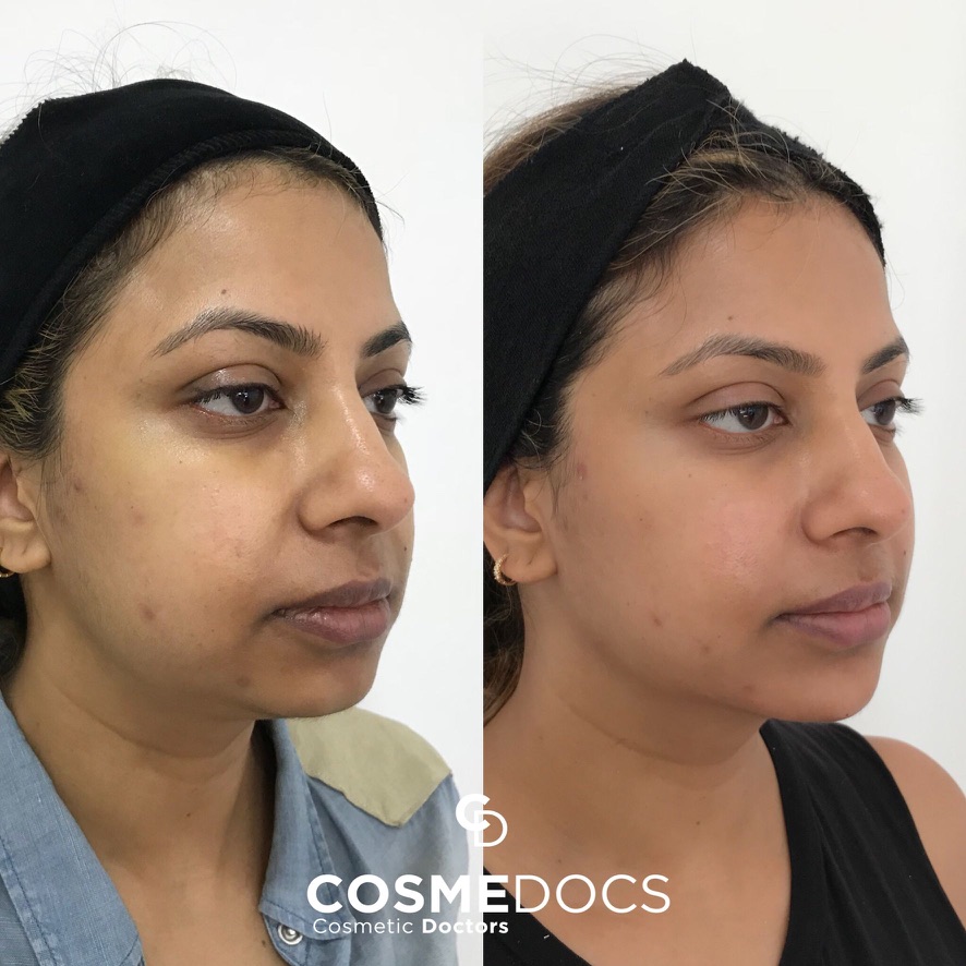 Before and after chin filler showing profile harmonisation and improved chin shape